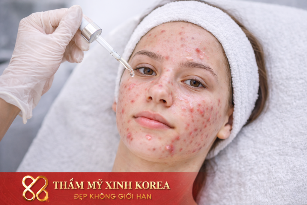Điều Trị Mụn Dậy Thì 2