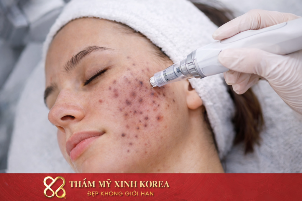 Điều Trị Mụn Thâm 2