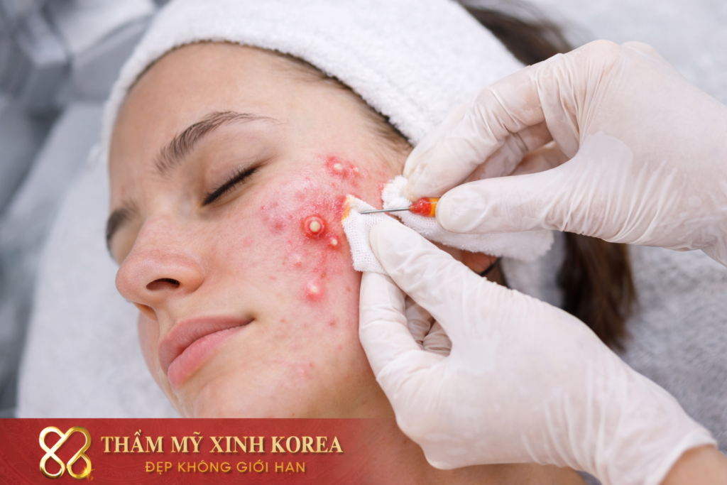 Điều Trị Mụn Bọc 2